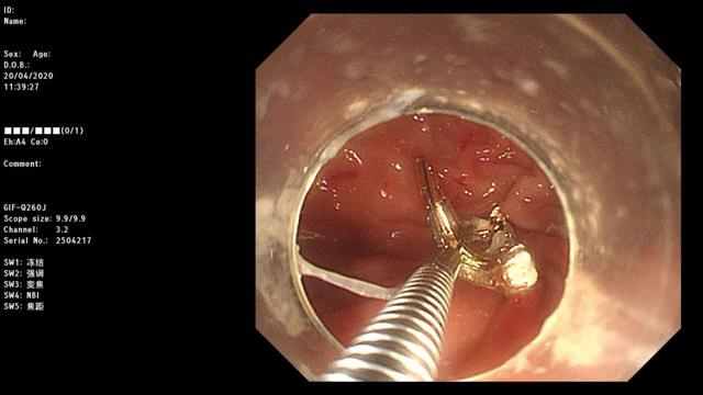 河北11个月大女婴吞下妈妈耳坠……__凤凰网