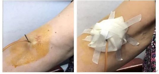 为什么输液要盖块纱布别再用这种针去扎输液港了！受伤的不仅仅是港体_https://www.jmylbn.com_新闻资讯_第1张