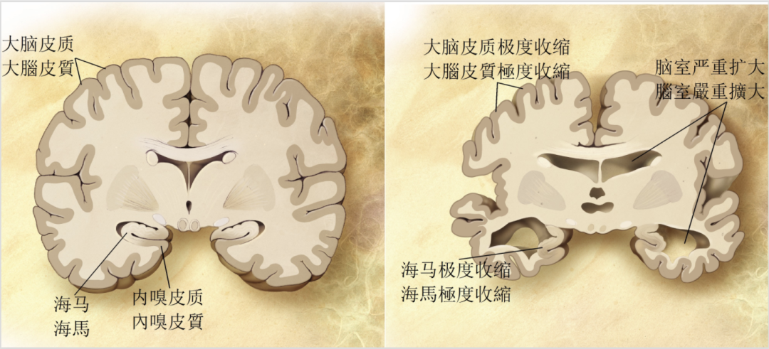 憶思能,加蘭他敏,愛憶欣),nmda 受體拮抗劑(美金剛胺)等,但迄今為止