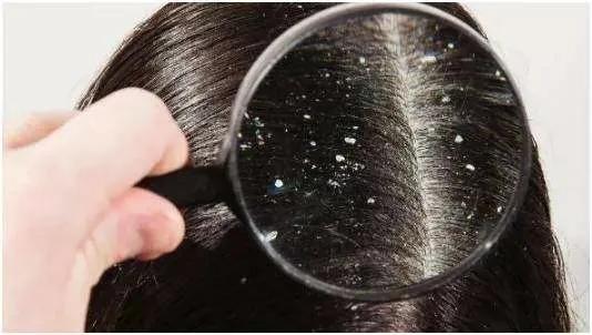 梦禾科普 如何对付烦人的头皮屑 凤凰网