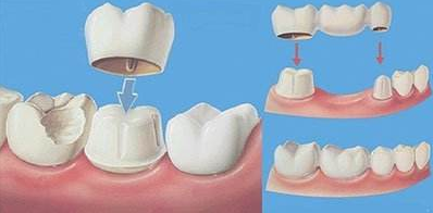 在廊坊牙齒缺失三種修復方式該選哪一個
