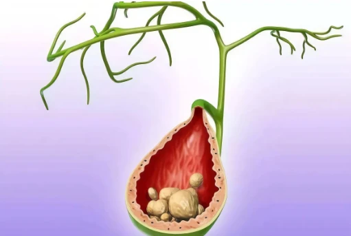 全面介紹一下膽結石有哪些症狀患上之後能吃什麼不能吃什麼