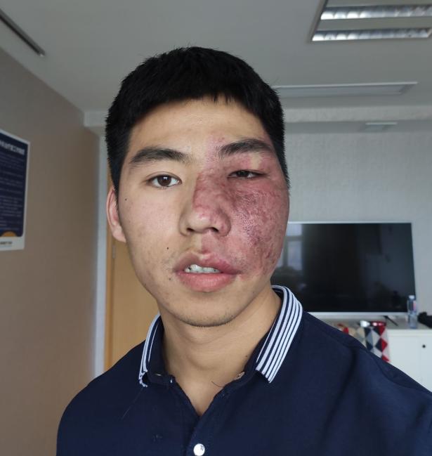 小伙脸上大面积红色斑痣为治疗在脸上装气球撑开皮肤