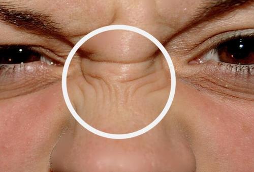 鼻子皱皮症图片