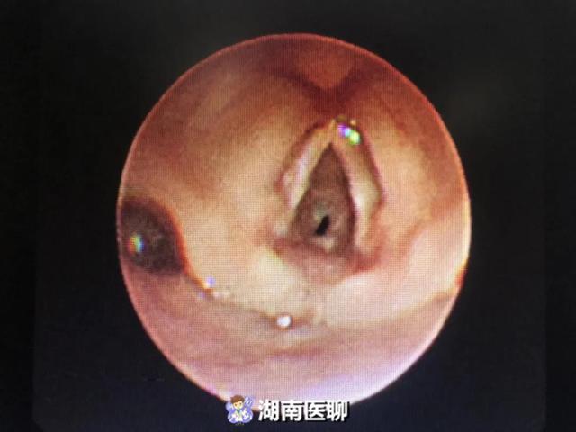 男婴嗓子眼仅剩米粒大空隙随时可能窒息生命之门该如何打通