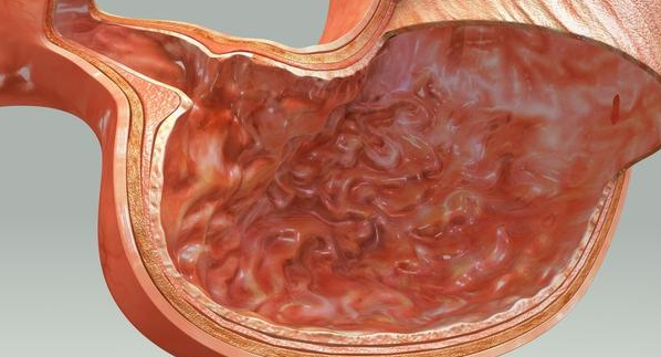 胃粘膜损坏严重会有4种表现3种方法修复胃粘膜胃越来越好