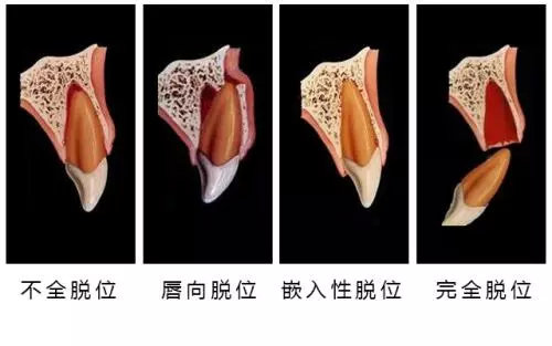 通常醫生會選擇植入骨粉/骨膜來幫助術後骨質更好地恢復,只有骨量達到