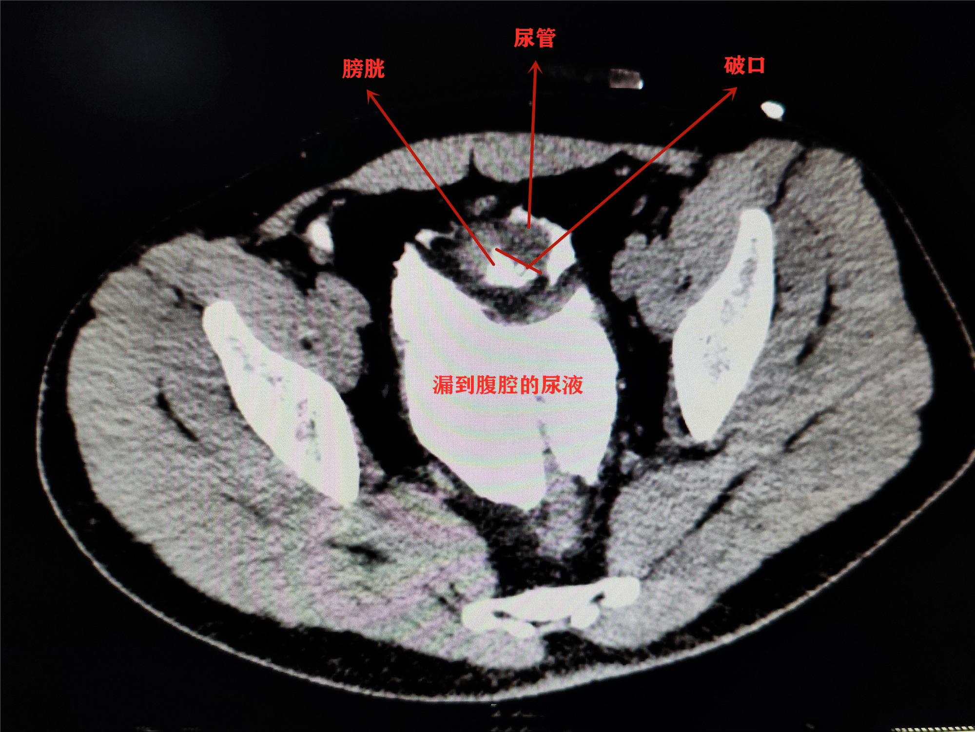膀胱破裂图片