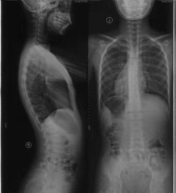 康睿仕案例分享:脊柱侧弯矫正,历时1个月体态有了较大明显改善