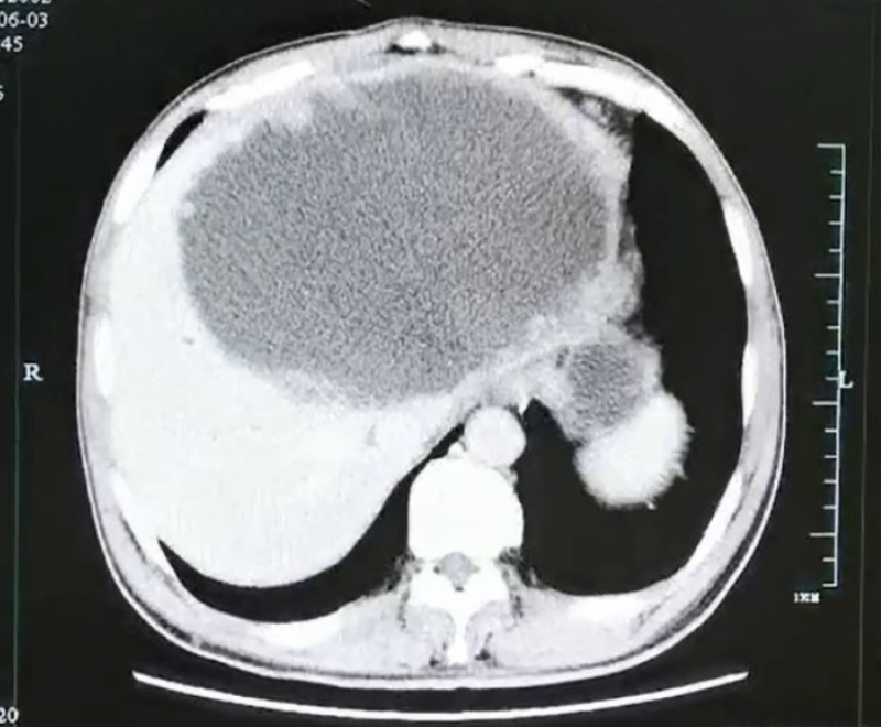 大脓球达到19cm×18cm×12cm大小.