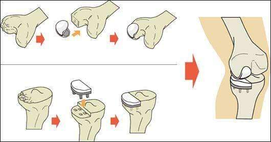 膝關節置換術後多久可以康復?__鳳凰網