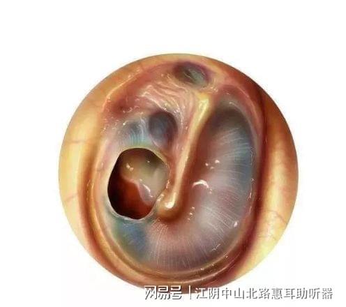 鼓膜穿孔危害这么大,需要做手术吗?__凤凰网