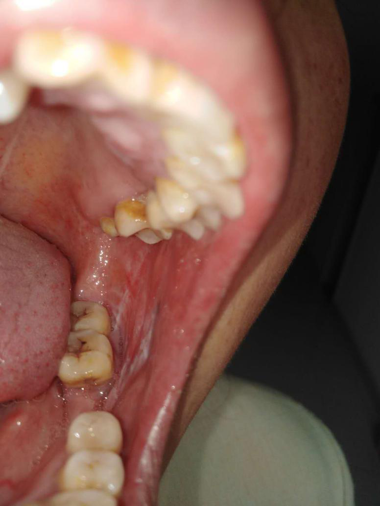 像丘疹,网状,糜烂(也叫破溃),斑块,水疱都是口腔扁平苔藓的常见症状