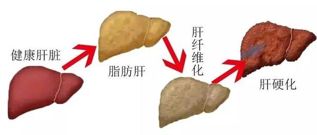 你知道肝癌腹水的发病原因是什么吗？肝癌腹水是怎么产生的？插图