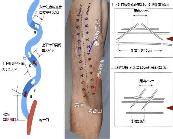 透析三种穿刺方法图片图片