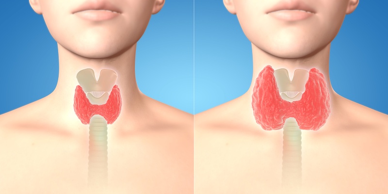 為何甲狀腺結節偏愛女性2類食物是誘因儘量少吃