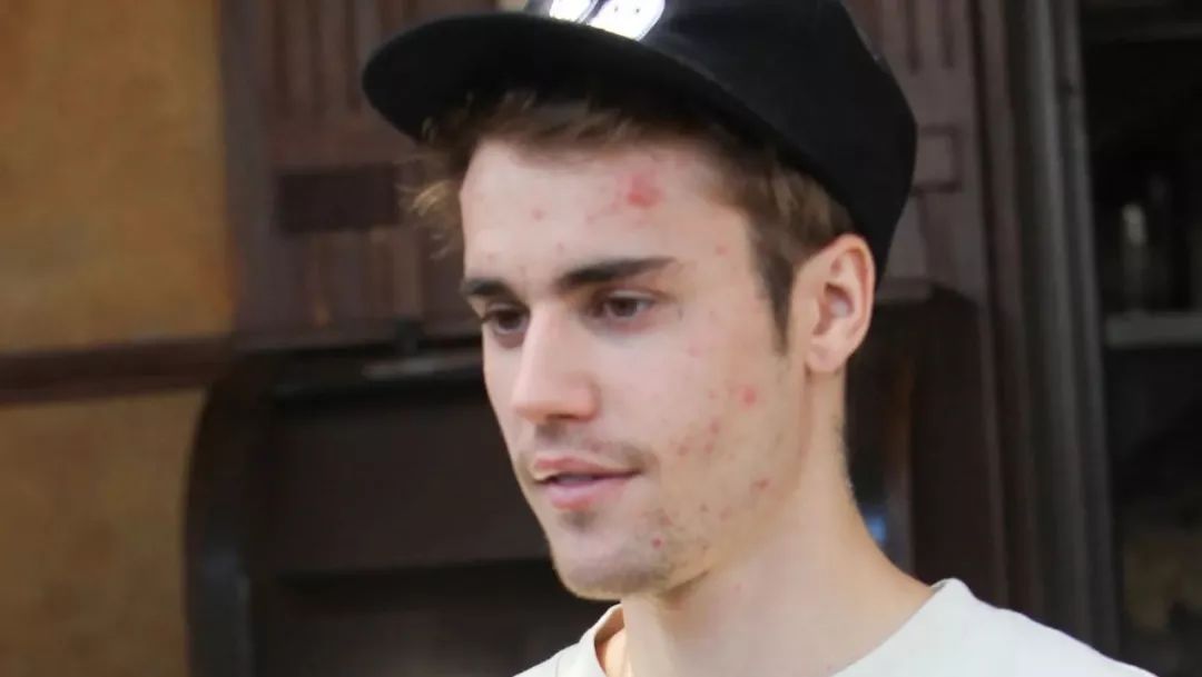 justinbieber自曝患萊姆病皮膚精神大腦都受打擊