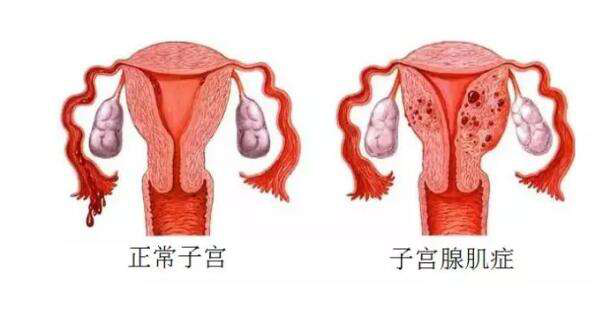 女人为什么会得子宫腺肌症?答案出来了!专家们终于达成了共识