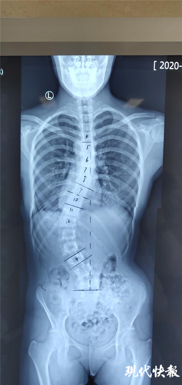 王伟 记者 张晓培)近日,徐州一14岁女生刚刚做完脊柱侧弯矫形手术