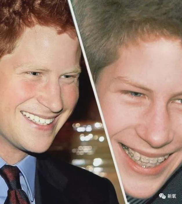 龅牙是皇室的标配?"突出"的贵气是这么来的?