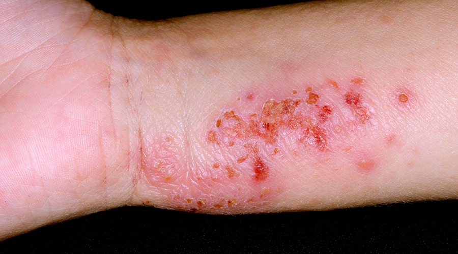 最终导致破损处的皮肤快速扩散引发顽固湿疹很容易引发感染,越抓越痒