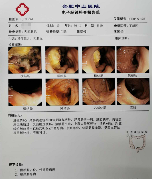 上覆大量坏死物,距肛缘50cm处见一肠息肉,检查结果显示:横结肠占位