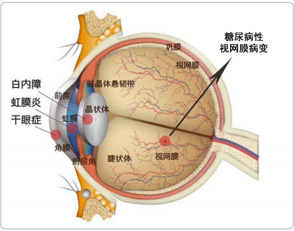 病变眼外肌——突发性麻痹性斜视晶状体——白内障虹膜——虹膜炎结膜