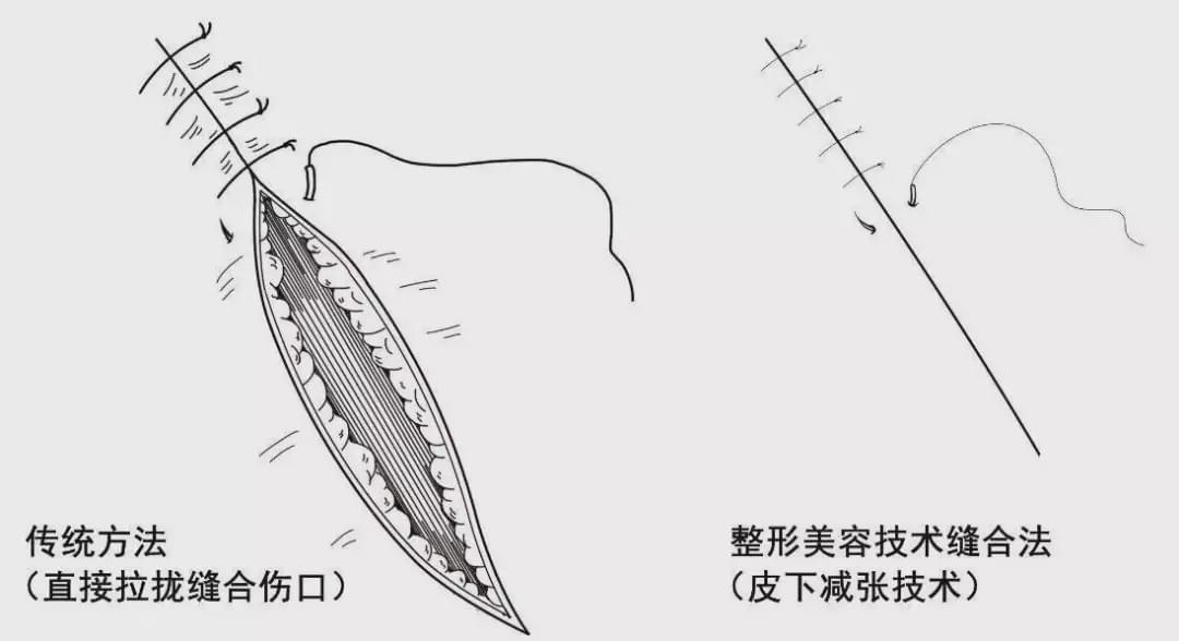 因为二次"伤害"的缝合处理得很精细,所以虽然也会产生瘢痕,但一些较小