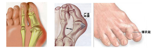 怎麼判斷自己有沒有踇趾外翻? 李