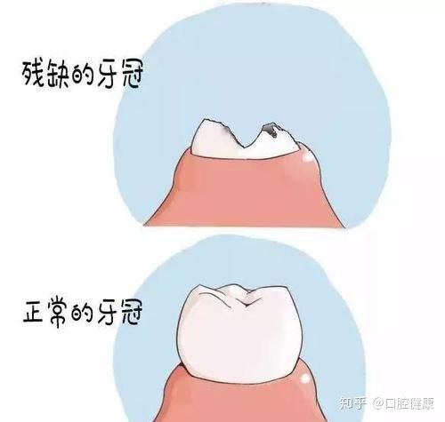 牙齿残根别乱拔留着能起大作用