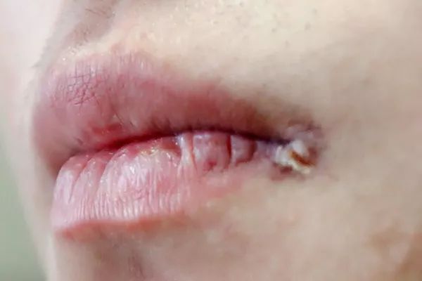 四五块钱一瓶的维生素b2,能治哪些病?别不当回事