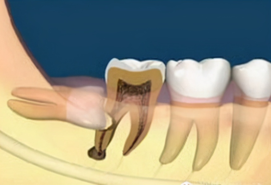 如何應對智齒帶來的不適哪些智齒是一定要拔的