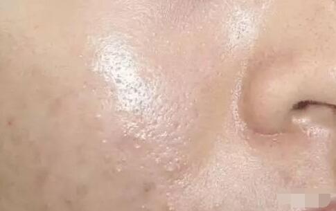 壹知肤:油皮就别玩儿命保湿了, 夏季油皮护肤全攻略_凤凰网