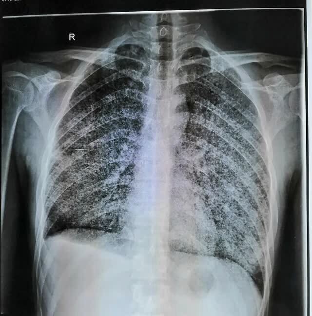 9 ℃,呼吸 22 次/分,脉率 110 次/分,躁动,说话不着调,听诊双肺呼吸音