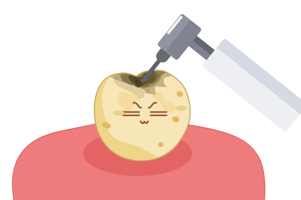 宝宝牙齿黑了,刷不掉就是蛀牙吗?