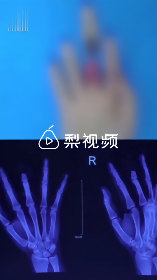 女孩玩耍时戒指挂住栅栏,纵身一跳扯断半截手指