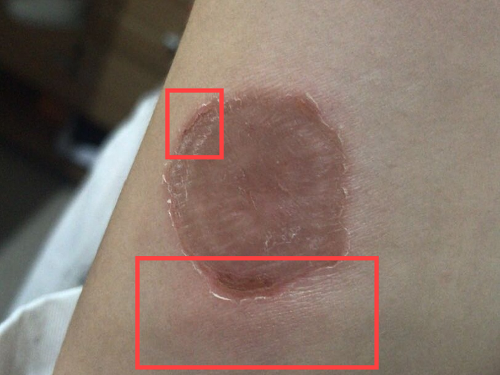 用小陈自己的话说,就是:"第一个人说自己得猫癣的时候,我们还在嘲笑他