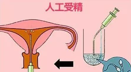 广州知名助孕公司（试管婴儿与人工授精的区别是什么，成功率分别是多少？）
