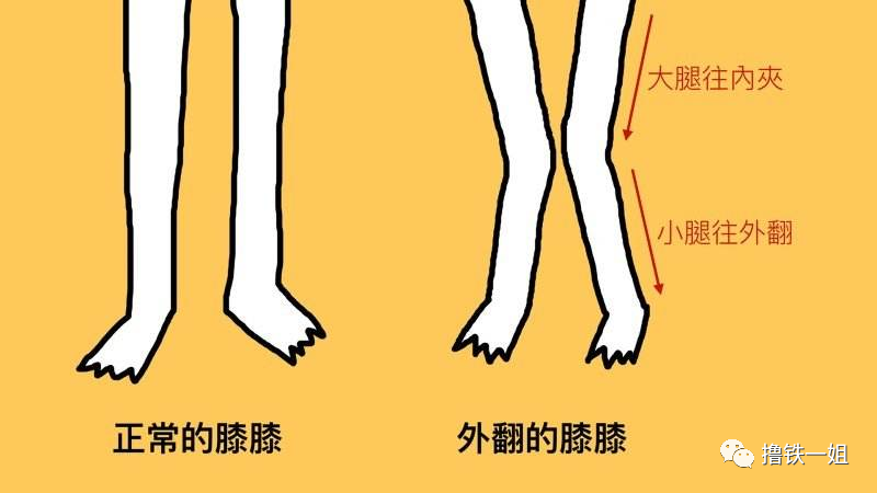 运动解剖学上,我们将这种情况称为膝外翻.