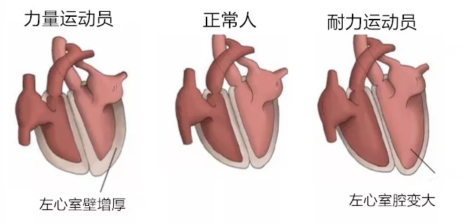 "运动员心脏",究竟是祝福还是诅咒? (二)