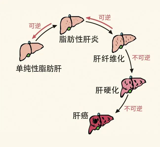 脂肪肝可以逆转牢记这几点战胜脂肪肝