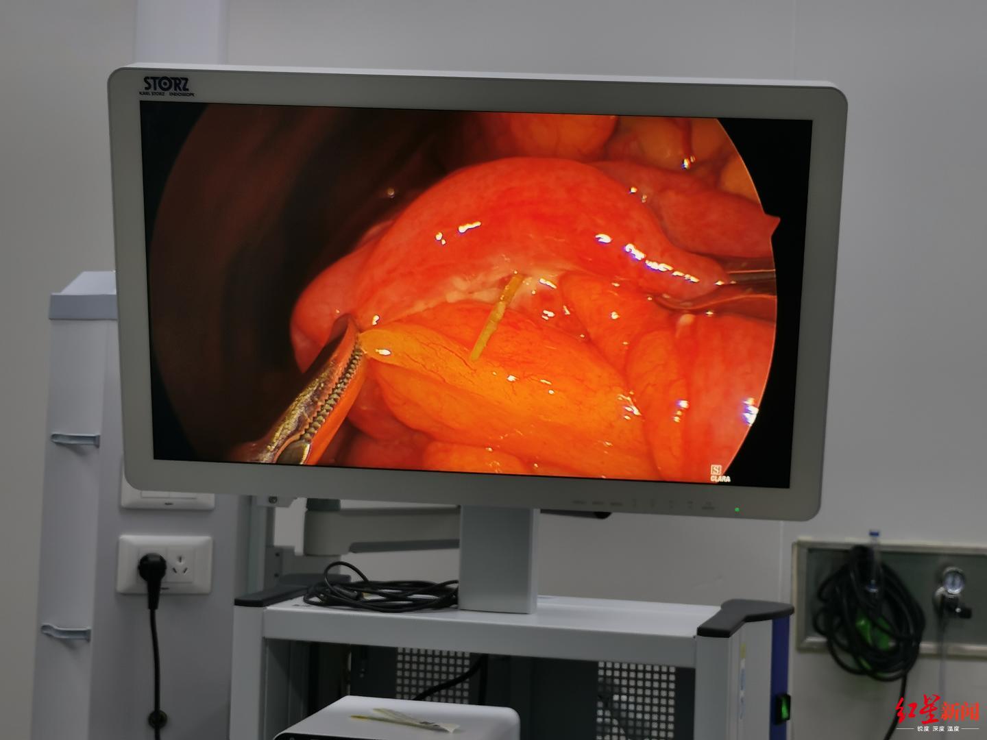 成都一女子涮火锅后肚子痛了几天原来是呛咳时误吞牙签导致肠穿孔