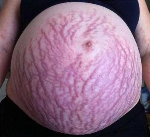 妊娠纹恶心图片妊娠线图片