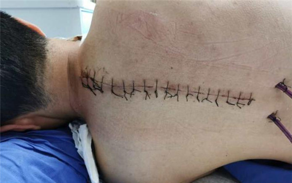 脊柱侧弯术后伤疤图片图片