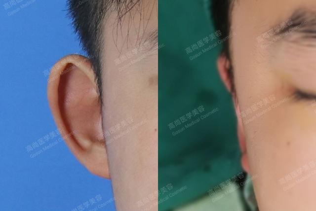 招风耳到底要不要矫正?__凤凰网