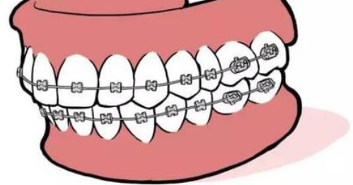 在廊坊矫正牙齿为什么托槽会掉