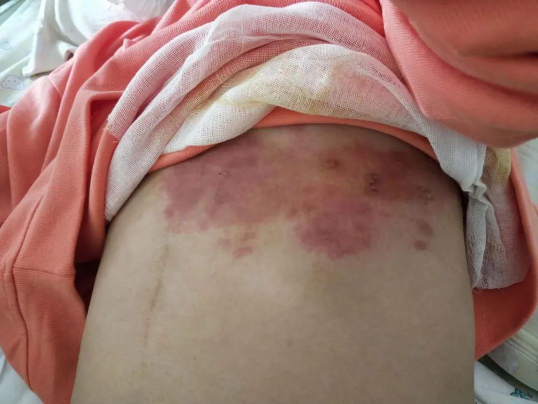 一例带状疱疹护理干预的案例分享