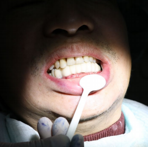 62岁退休工人,下牙缺失6颗并伴有牙槽骨萎缩,十分痛苦!