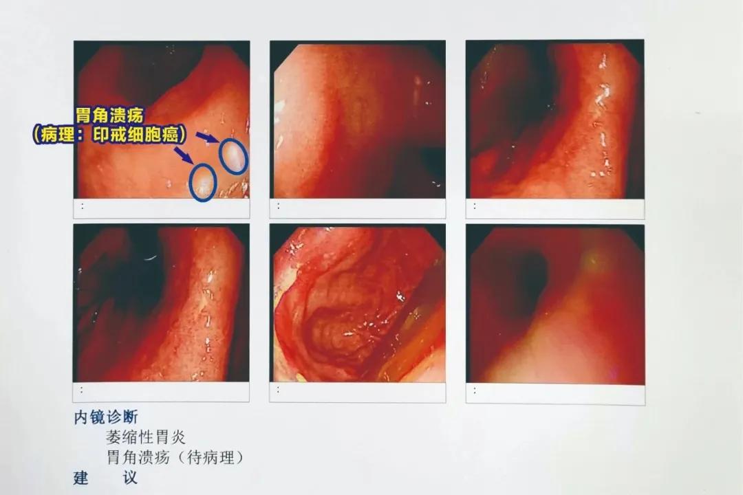 56歲的丁阿姨,兩年前做體檢的時候,發現幽門螺桿菌陽性,但是平時胃也