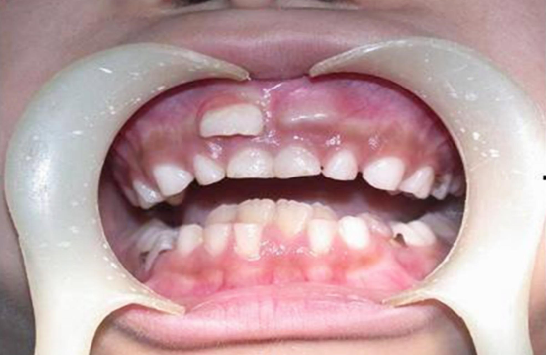多生牙牙根多长?图片图片